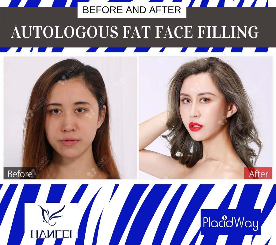 Fat Face Fillers Before and After, Guangzhou, China